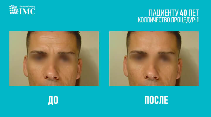 Ботулотоксин до и после