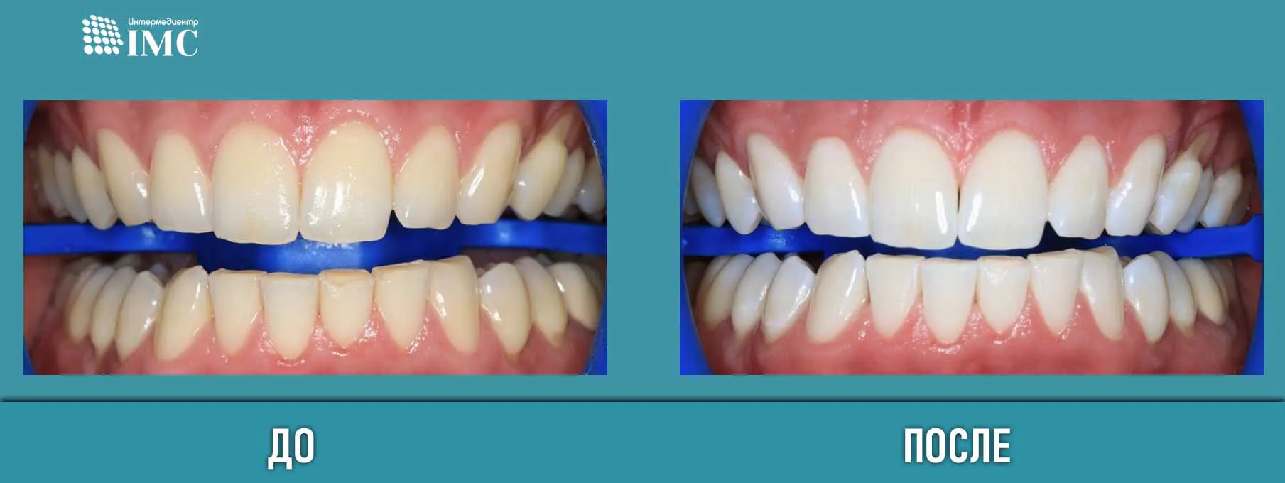 Отбеливание зубов zoom 4 в воронеже зубная щетка oral b 3d white deluxe