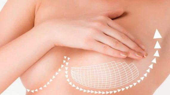 Увеличение груди в летнее время, мифы и преимущества летней маммопластики