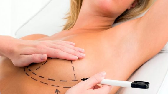О подтяжке груди (Мастопексия) - эстетическая операция для улучшения контура и формы молочных желез
