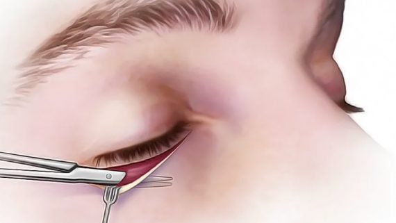 Кантопластика (изменение разреза глаз) - что это такое, описание операции до и после